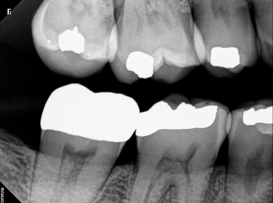 Taking Bitewing Dental X Rays